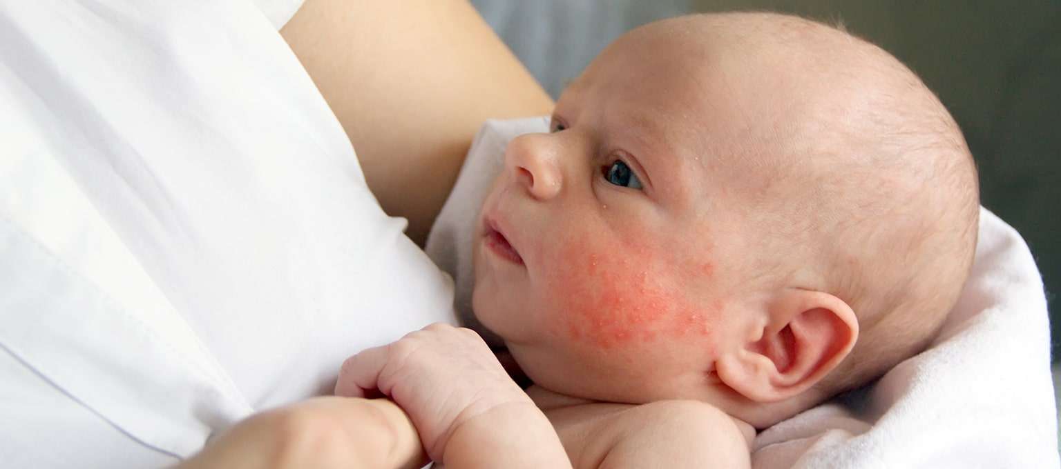 How To Get Rid Of Baby Heat Rash On Face