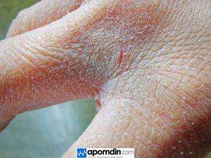 Dried cracked hands home remedies