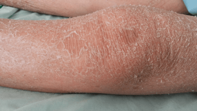 home remedies of dry skin