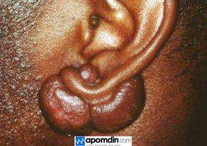 Home remedies for keloid