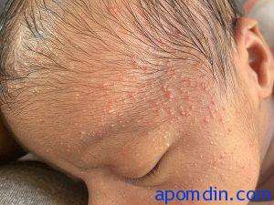 Home remedies for baby face rashes